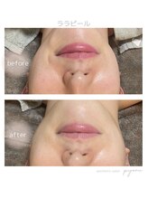 ピョル(pyoru)/ララピール1回施術にて