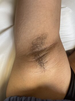 フレドネ(FREDONNER)/脇ワックス脱毛Before