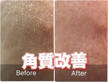 【生涯の素肌管理をサポート】松ヤニWAXで肌質/毛穴/ニキビ改善