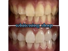 ホワイトニングショップ 池田店/【BEFORE/AFTER】