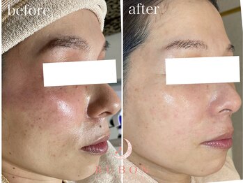 トータルビューティサロン ルボン(RUBON)/シミ、赤み改善