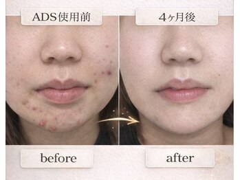 プリベンティブ ビューティー ティップス(Preventive Beauty Tips)/ニキビ改善ビフォーアフター