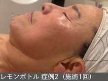 オアシスラグーン(OASIS LAGOON)/レモンボトル（症例2 施術1回）