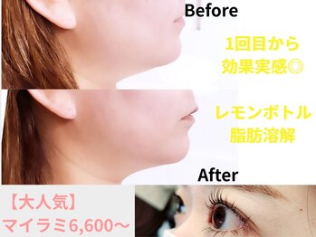 ココンフワット(Coconfouato)の写真/【韓国発!!頑固な脂肪を徹底分解◇】レモンボトルフェイスライン¥9900～♪≪ダウンタイム・ハリ無し≫