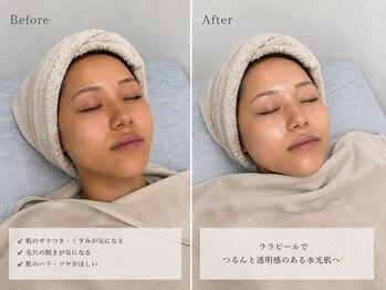 サロンドルル(salon de lulu.)の写真/ハイドラ毛穴洗浄×鎮静パックで感動の素肌へ!徹底美肌ケアでノーファンデを叶えるサロン♪