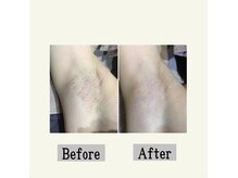 ペールノエル 静岡店(PERE NOEL)/脱毛(20代女性)