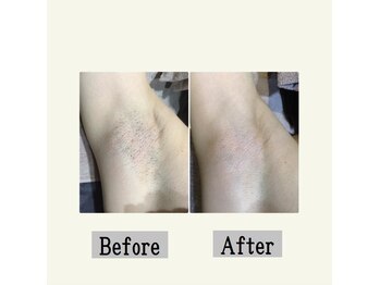 ペールノエル 静岡店(PERE NOEL)/脱毛(20代女性)