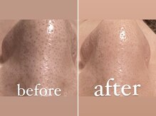 マイア(MYA)/鼻毛穴ビフォーアフター