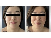 マリー エクラン/４０代女性　リフトUP施術