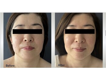 マリー エクラン/40代女性 リフトUP施術