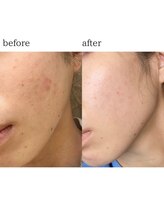 ラナ(Lana)/ラピエラピーリング