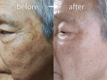 アルカンシエル(arcenciel)/シミ・シワ改善コース