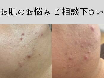 マーベル(MaaBelle)/水光肌ピーリング