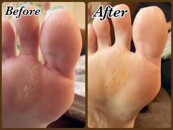 ビューティースパ(Beauty-Spa)/【タコ・ウオノメの角質除去】