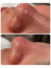 ラナン(ranan)/毛穴洗浄