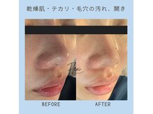 フレキシ 表参道(Flexi)の雰囲気（毛穴の詰まりや開きにはピーリングの酸と保湿力が必須◎）