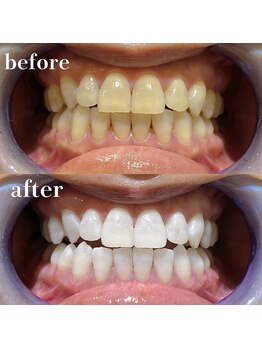 ティアラ 葛西店(TIARA)/セルフホワイトニングの効果実感