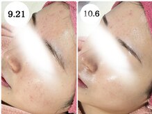 ゆらり/急な肌トラブルケア