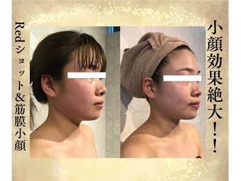 サンテボーテ(Sante Beaute)/Redショット導入＆小顔筋膜