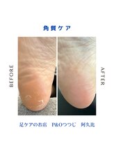 ピーアンドオー(P&O)/角質ケア
