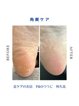 ピーアンドオー(P&O)/角質ケア