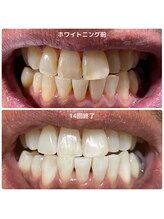 ワイズサロン(Y's salon)/ホワイトニング14回終了！