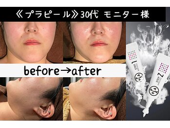 サロンスペース/水光肌【プラピール】モニター様