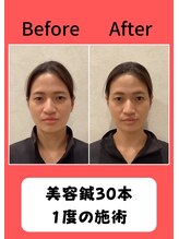 六花鍼灸整骨院 天神店/ほうれい線や乾燥に肌に美容鍼