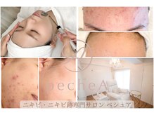 ペシュア(pecheA)の雰囲気（通えば通う程結果の出るニキビケア専門店根深いお悩み解消！）