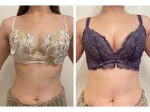 美人バスト 本厚木店/バストアップ◇症例◇