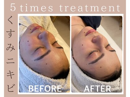 ハーブピーリング 恵比寿の写真