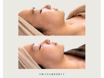 SALON DE Cの写真/韓国マイクロフェイスリフト導入!結果重視サロンの即効性◎小顔メニュー!全顔◇トリートメント同時体験も◎