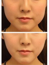 アンベリ(Embelli)/