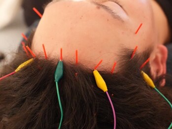 あたまの再起動の写真/《睡眠の質UP・眼精疲労/肩こり解消》あたまの鍼×電気で不調を改善!お仕事の集中力を高めます◎