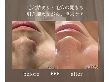 エメ(eme)/つまり毛穴と開き毛穴 W毛穴