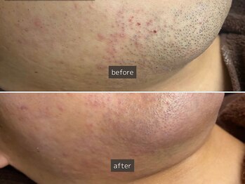 SEC(Shizuoka esthetic company)/【メンズ】脱毛2回