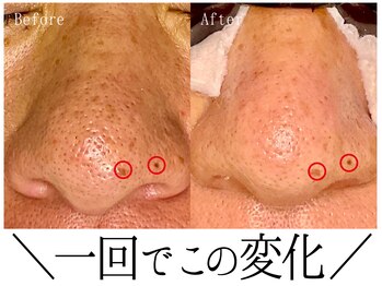 スポット 薬院駅前店(SPOT)/男女の毛穴肌悩みお任せください