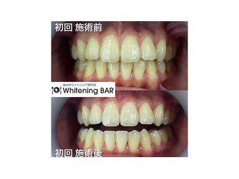 ホワイトニングバー 心斎橋オーパ店/初回来店ケア後ビフォーアフター