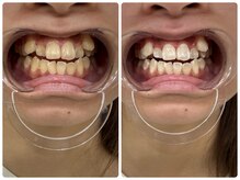 コナホワイトニング 神保町/神保町ホワイトニングビフォア