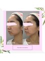 スリムライン 青森店(The Slim Line) 【モニター様Before/After】フェイシャル1回です