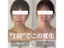 ティセ(TisseR)/小顔施術　脳洗浄