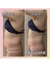 プリマジュール/【話題の痩身】圧倒的な変化