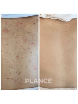 プランス 渋谷(PLANCE)/毛穴/ハーブ/ニキビケア