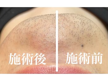 脱毛 フェイシャルサロン ケア(CARE)/［脱毛：3］メンズ脱毛も強い！