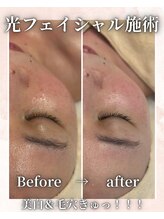フィズ 海老名店(FIS)/光フェイシャル