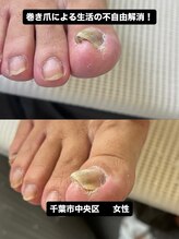 巻き爪じゅん 船橋店/巻き爪で歩けなかった毎日を解消