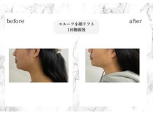 トキ(TOKI)/ユルーフ小顔リフト　直後1