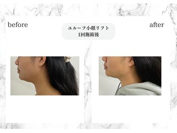 トキ(TOKI)/ユルーフ小顔リフト 直後1
