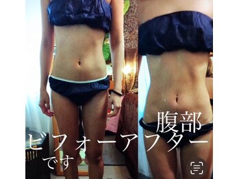 ラ ペジヴル(la Paisible)の写真/冷却凍結マシーン…お腹の浮き輪を何とかしたいに答えて、冷却凍結の最先端マシーンで脂肪細胞にサヨウナラ
