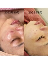 レイネイル レイエステティック 岐阜茜部店(RAY NAIL & RAY ESTHETIC)/マイクロニードルピーリング
